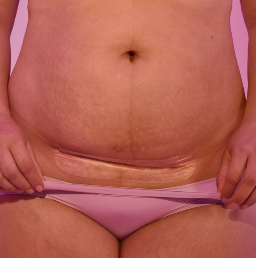 C-Section Silicone Scar Patches